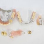 金歯 入れ歯 歯科金属 入れ歯金歯